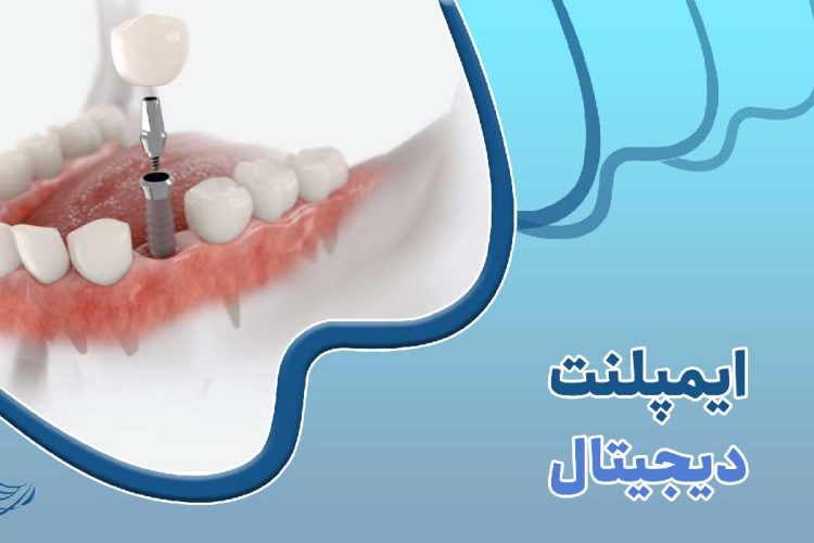 ایمپلنت دیجیتال چیست؟